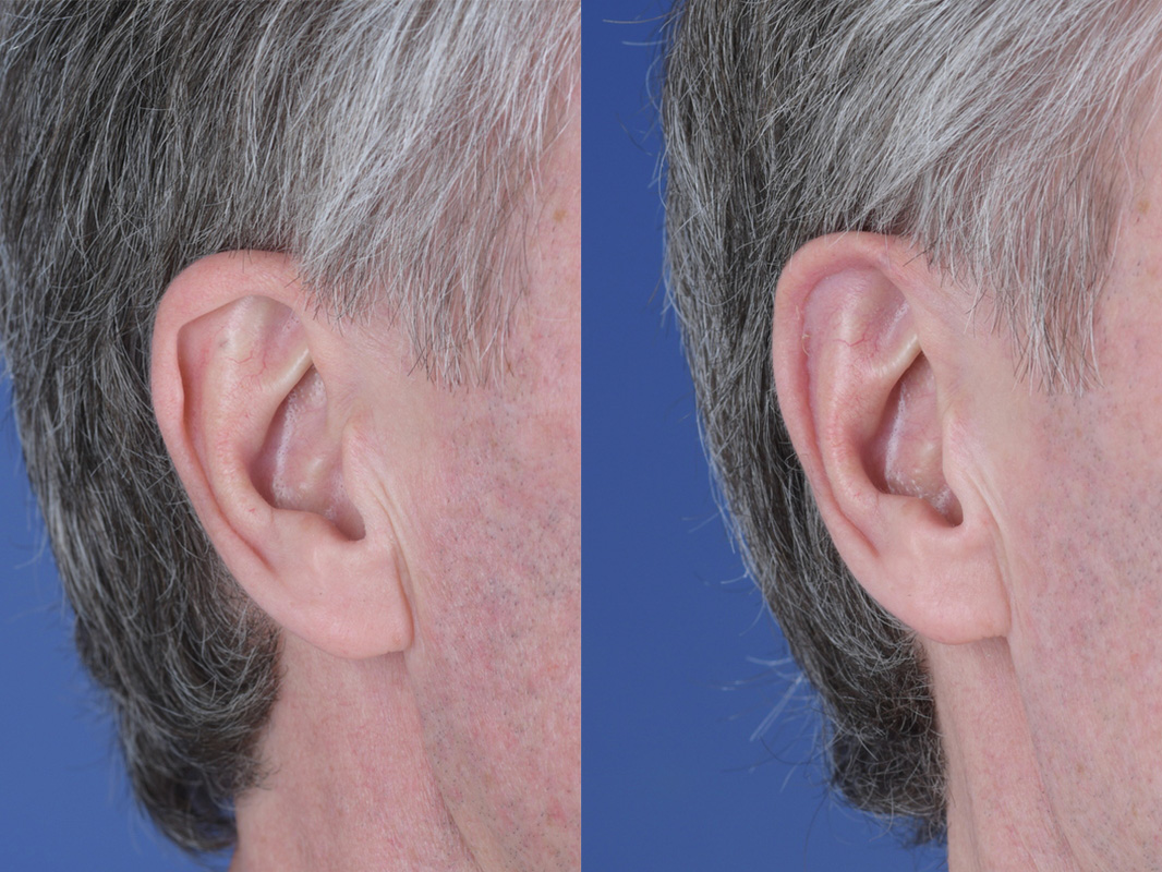Otoplasty Before and After | Weber Facial Plastic Surgery
