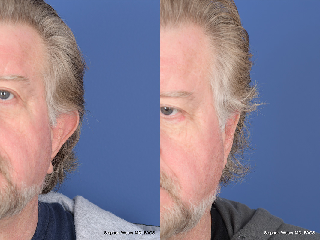 Otoplasty Before and After | Weber Facial Plastic Surgery