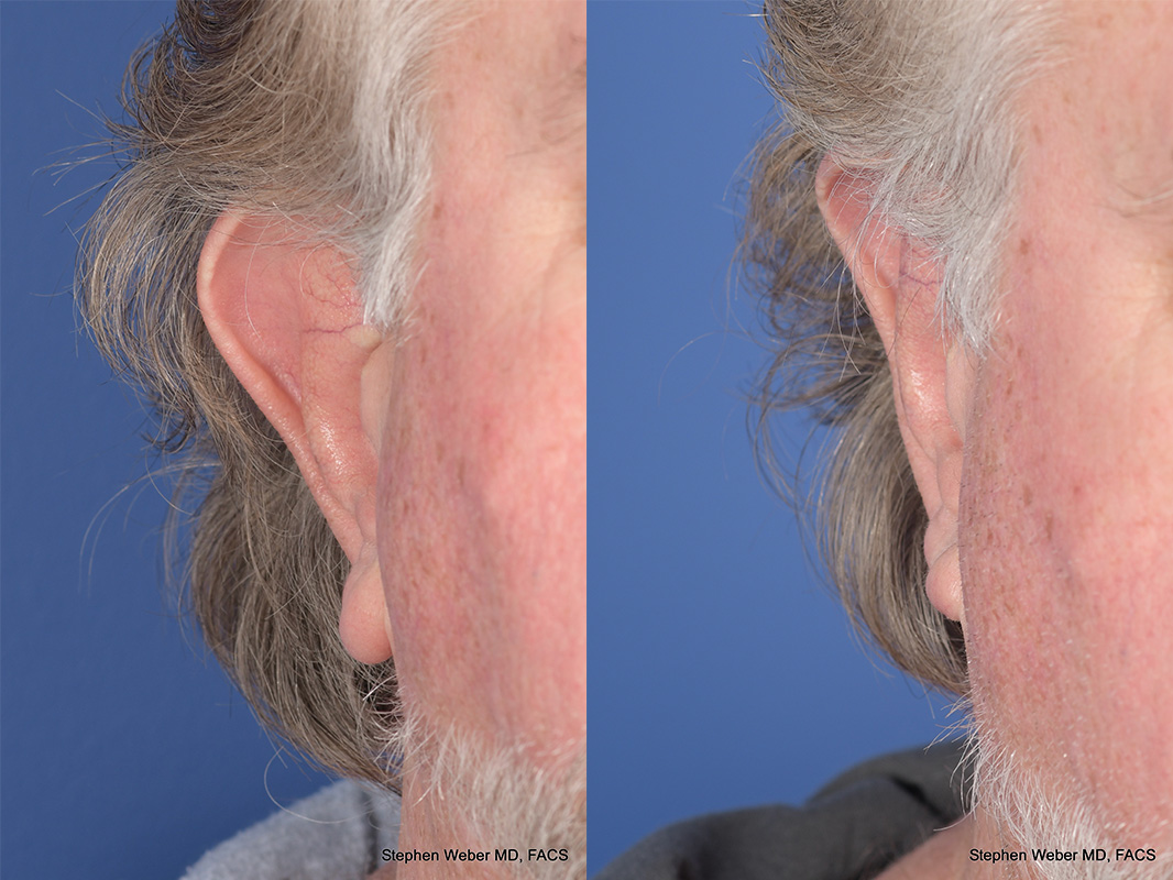 Otoplasty Before and After | Weber Facial Plastic Surgery
