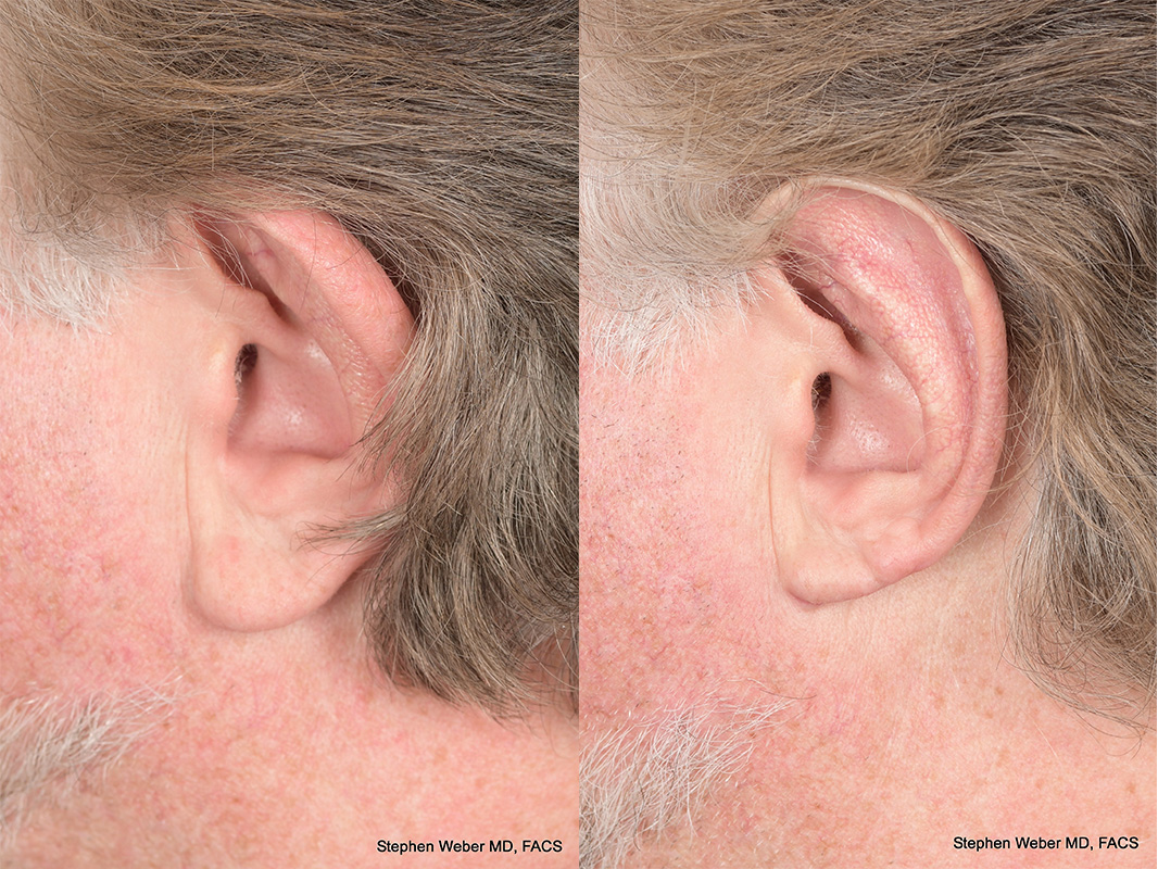 Otoplasty Before and After | Weber Facial Plastic Surgery