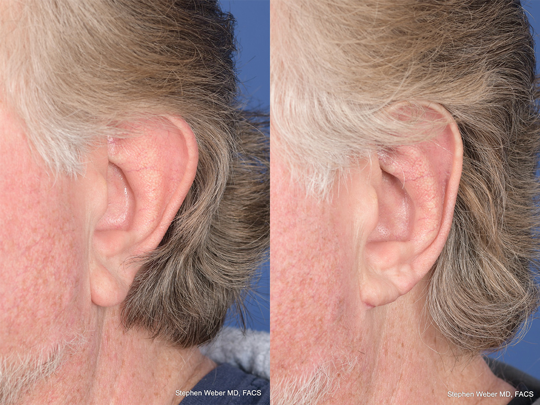 Otoplasty Before and After | Weber Facial Plastic Surgery