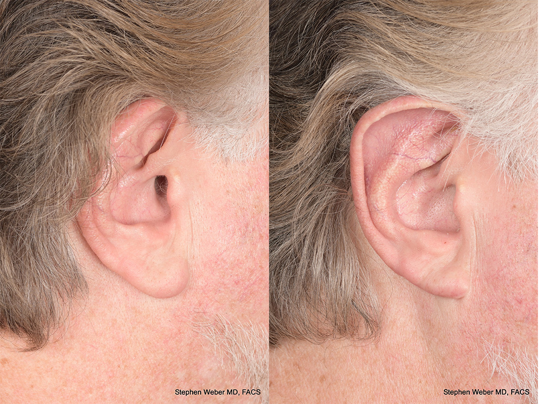Otoplasty Before and After | Weber Facial Plastic Surgery