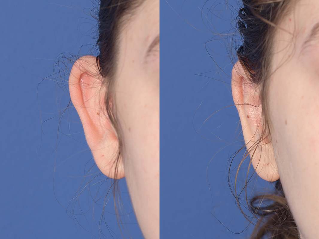Otoplasty Before and After | Weber Facial Plastic Surgery