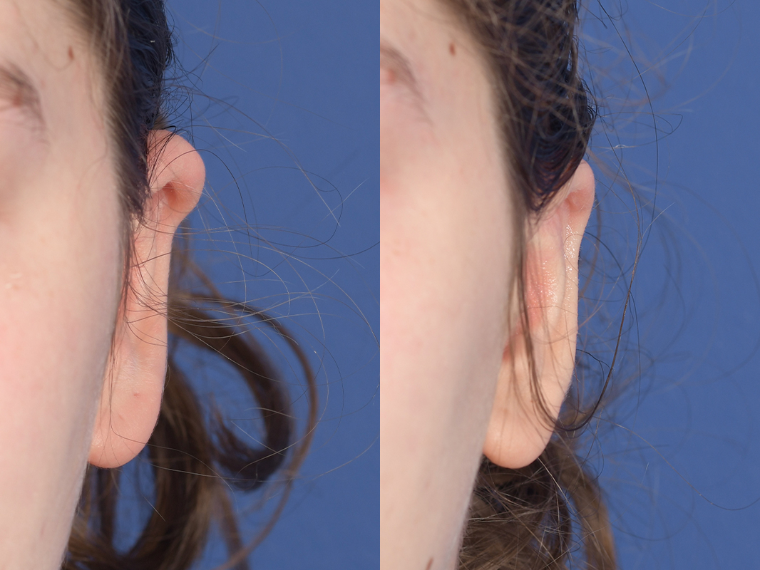 Otoplasty Before and After | Weber Facial Plastic Surgery