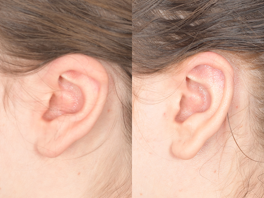 Otoplasty Before and After | Weber Facial Plastic Surgery