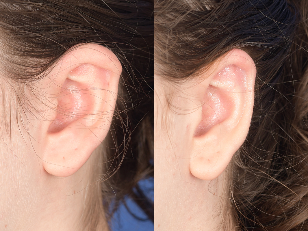Otoplasty Before and After | Weber Facial Plastic Surgery