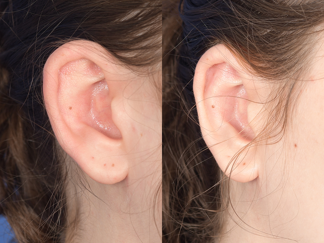 Otoplasty Before and After | Weber Facial Plastic Surgery