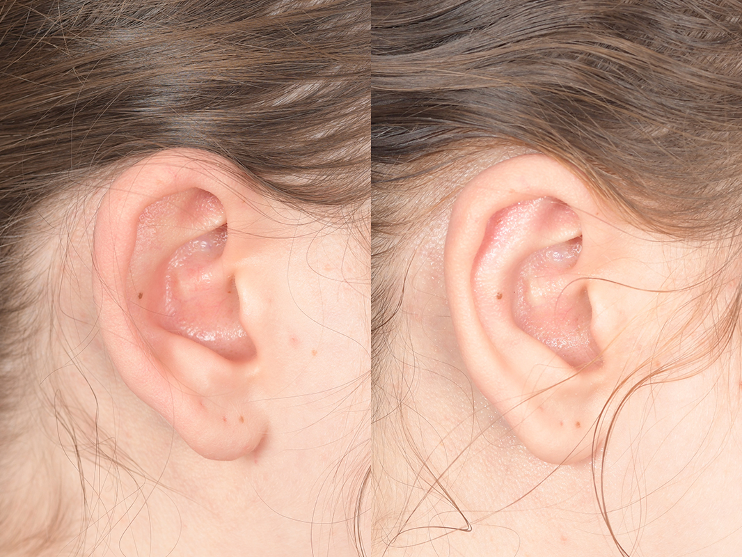 Otoplasty Before and After | Weber Facial Plastic Surgery
