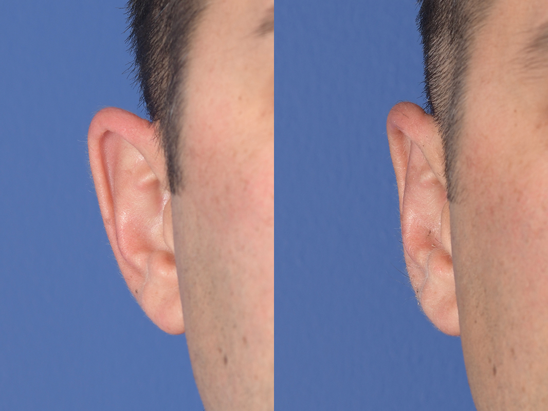 Otoplasty Before and After | Weber Facial Plastic Surgery