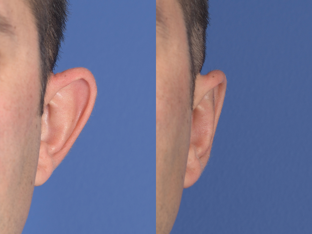Otoplasty Before and After | Weber Facial Plastic Surgery
