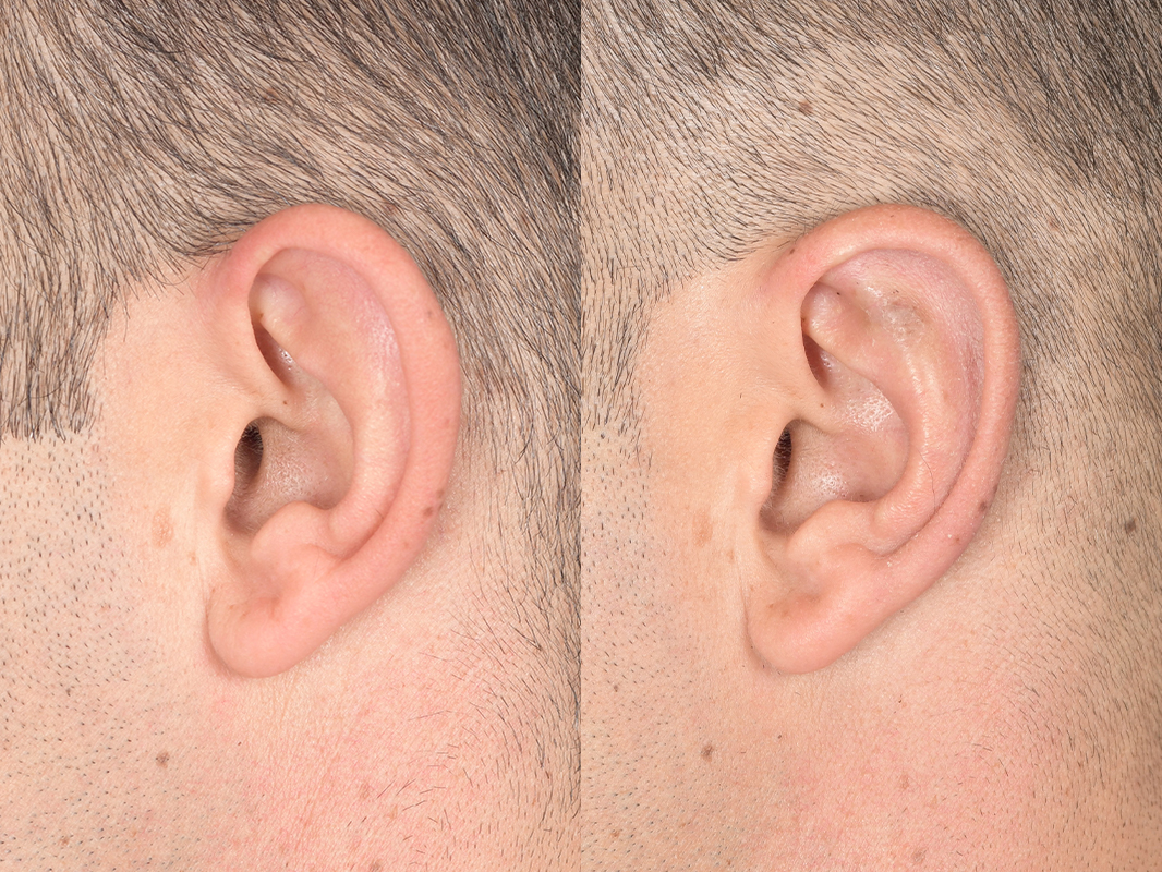 Otoplasty Before and After | Weber Facial Plastic Surgery