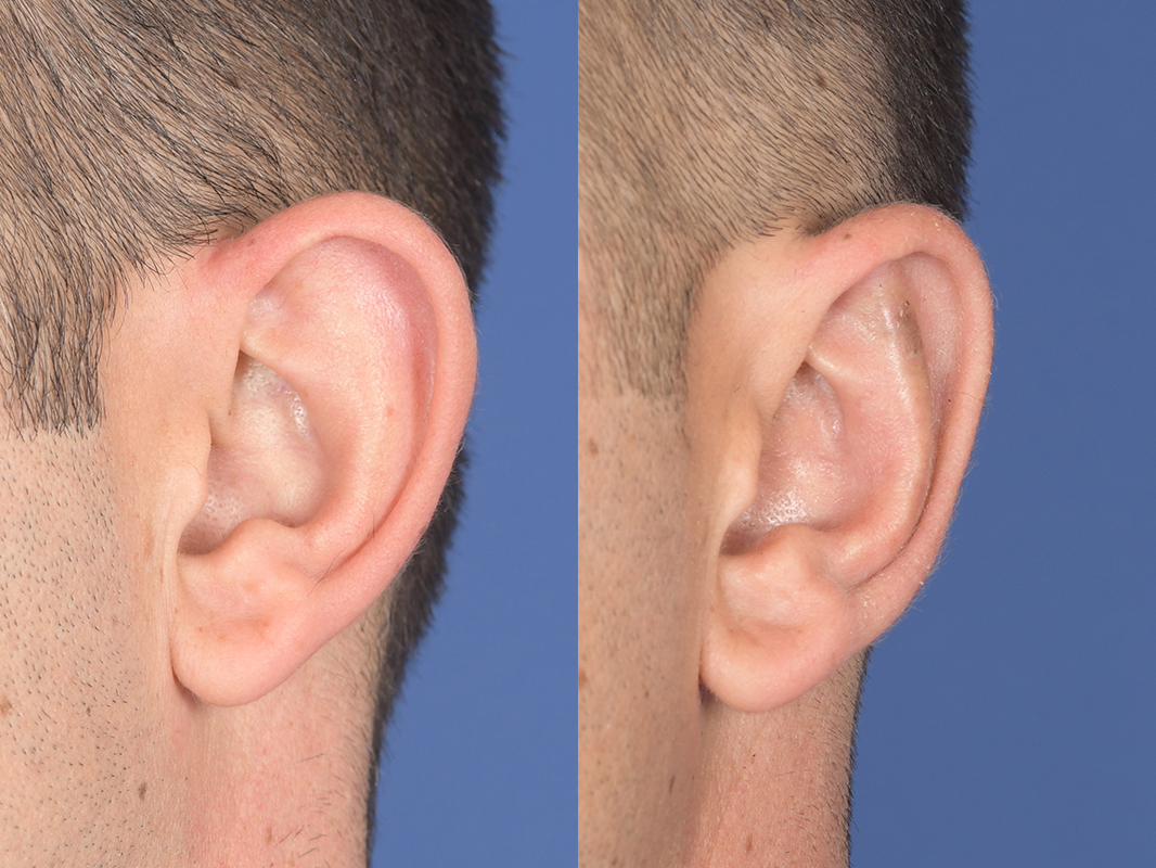 Otoplasty Before and After | Weber Facial Plastic Surgery