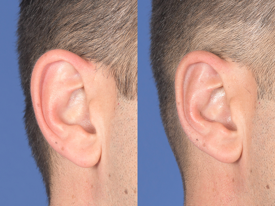 Otoplasty Before and After | Weber Facial Plastic Surgery