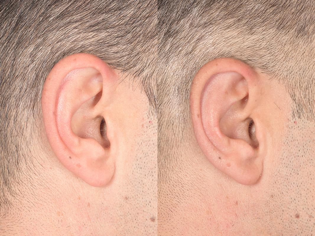 Otoplasty Before and After | Weber Facial Plastic Surgery
