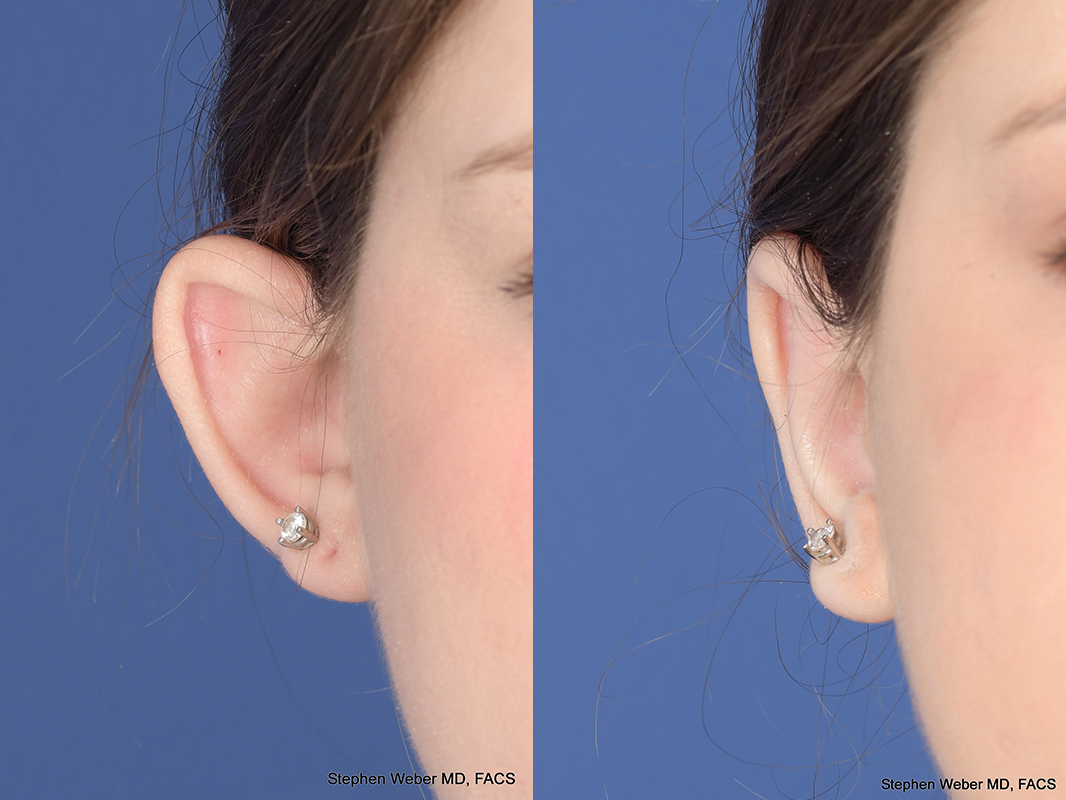 Otoplasty Before and After | Weber Facial Plastic Surgery