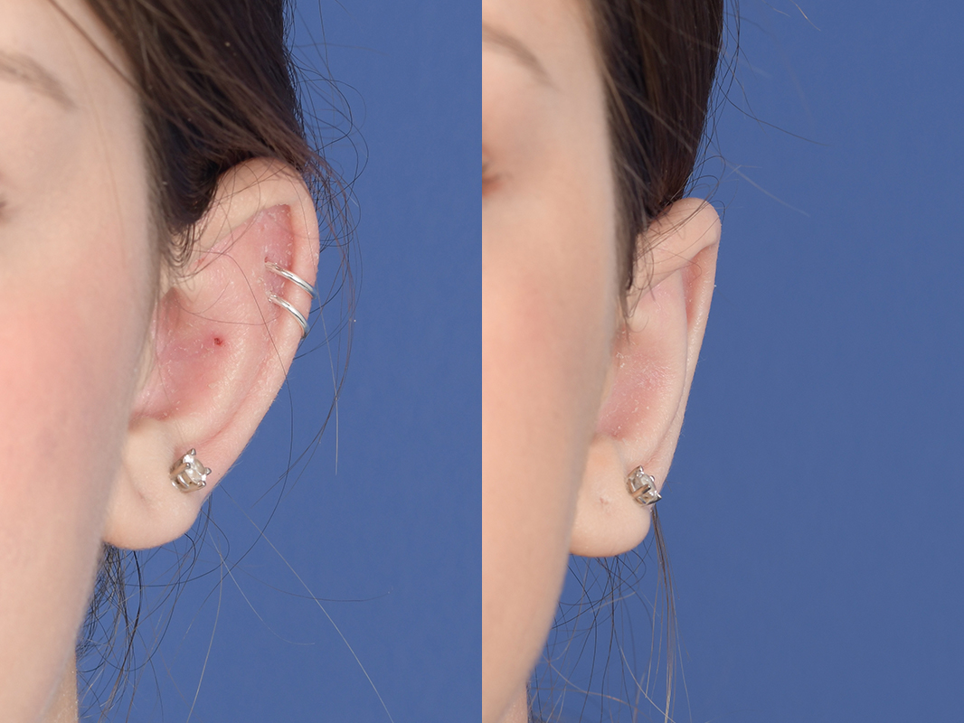 Otoplasty Before and After | Weber Facial Plastic Surgery