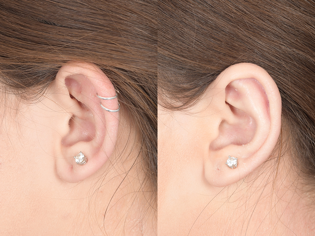 Otoplasty Before and After | Weber Facial Plastic Surgery
