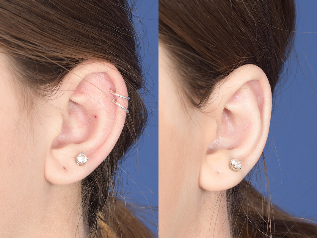 Otoplasty Before and After | Weber Facial Plastic Surgery