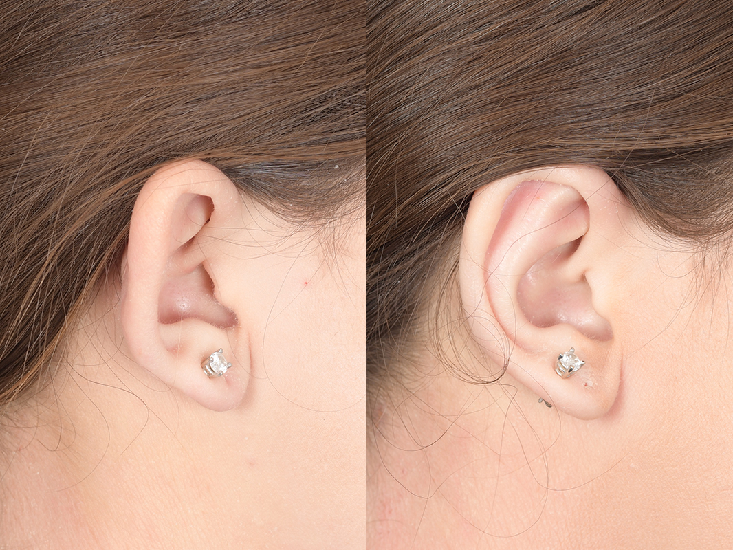 Otoplasty Before and After | Weber Facial Plastic Surgery