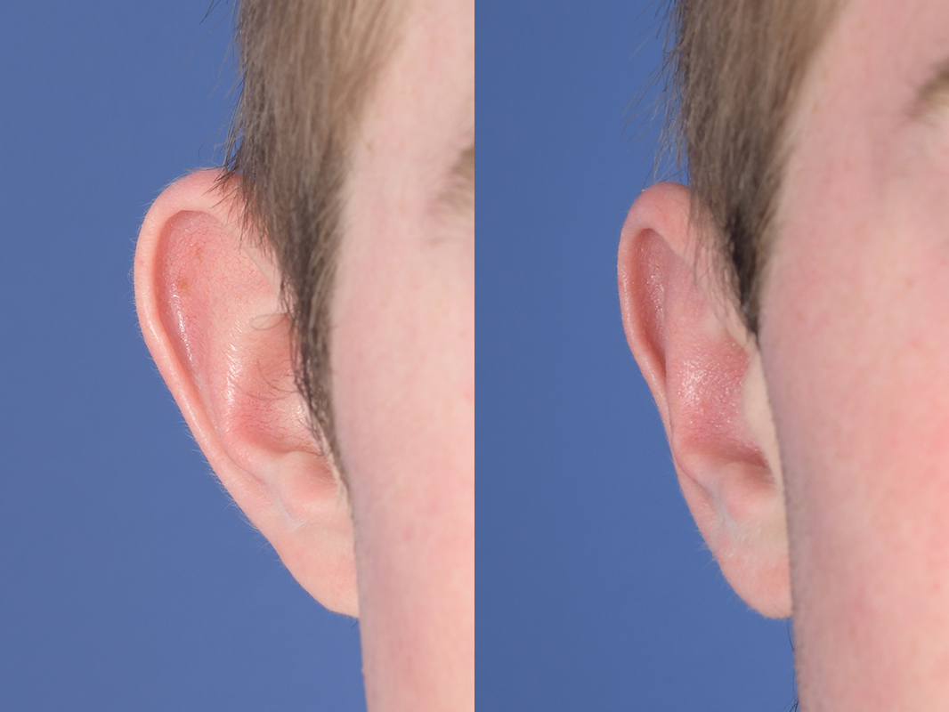 Otoplasty Before and After | Weber Facial Plastic Surgery