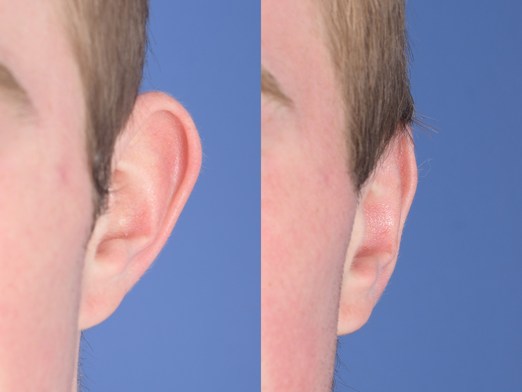 Otoplasty Before and After | Weber Facial Plastic Surgery