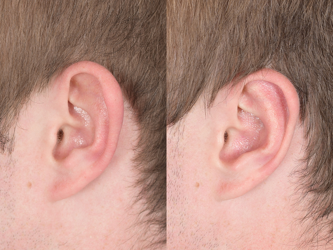 Otoplasty Before and After | Weber Facial Plastic Surgery