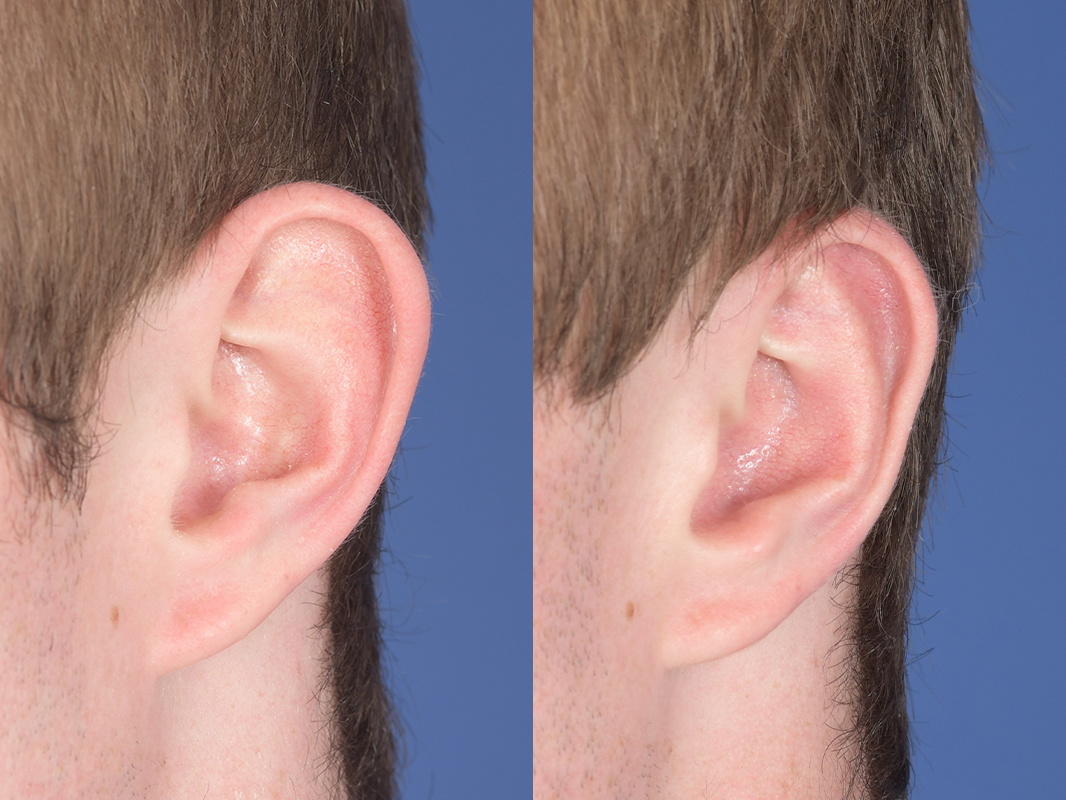 Otoplasty Before and After | Weber Facial Plastic Surgery