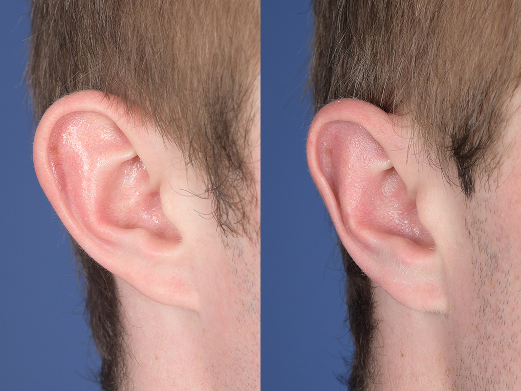 Otoplasty Before and After | Weber Facial Plastic Surgery