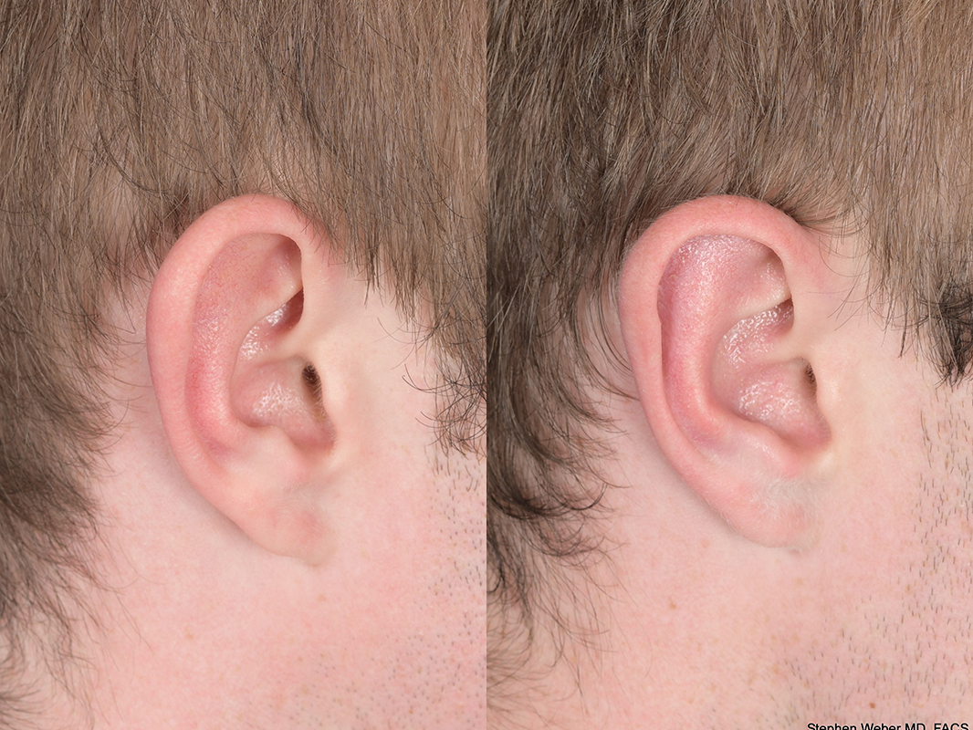 Otoplasty Before and After | Weber Facial Plastic Surgery