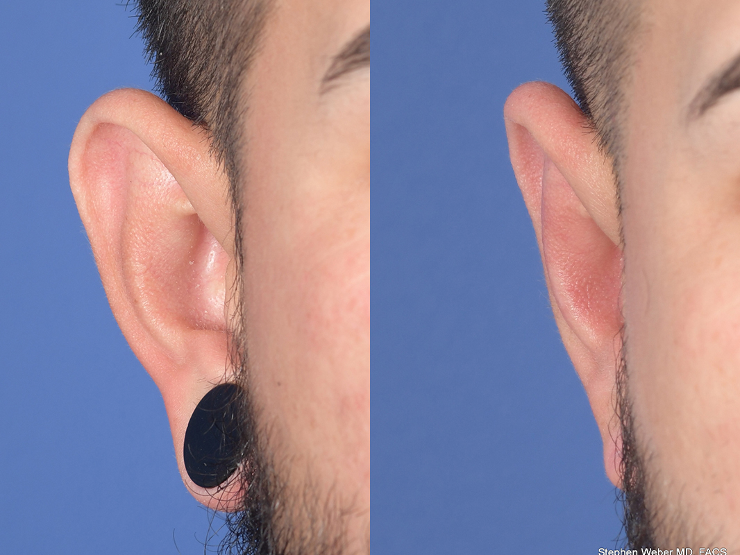 Otoplasty Before and After | Weber Facial Plastic Surgery