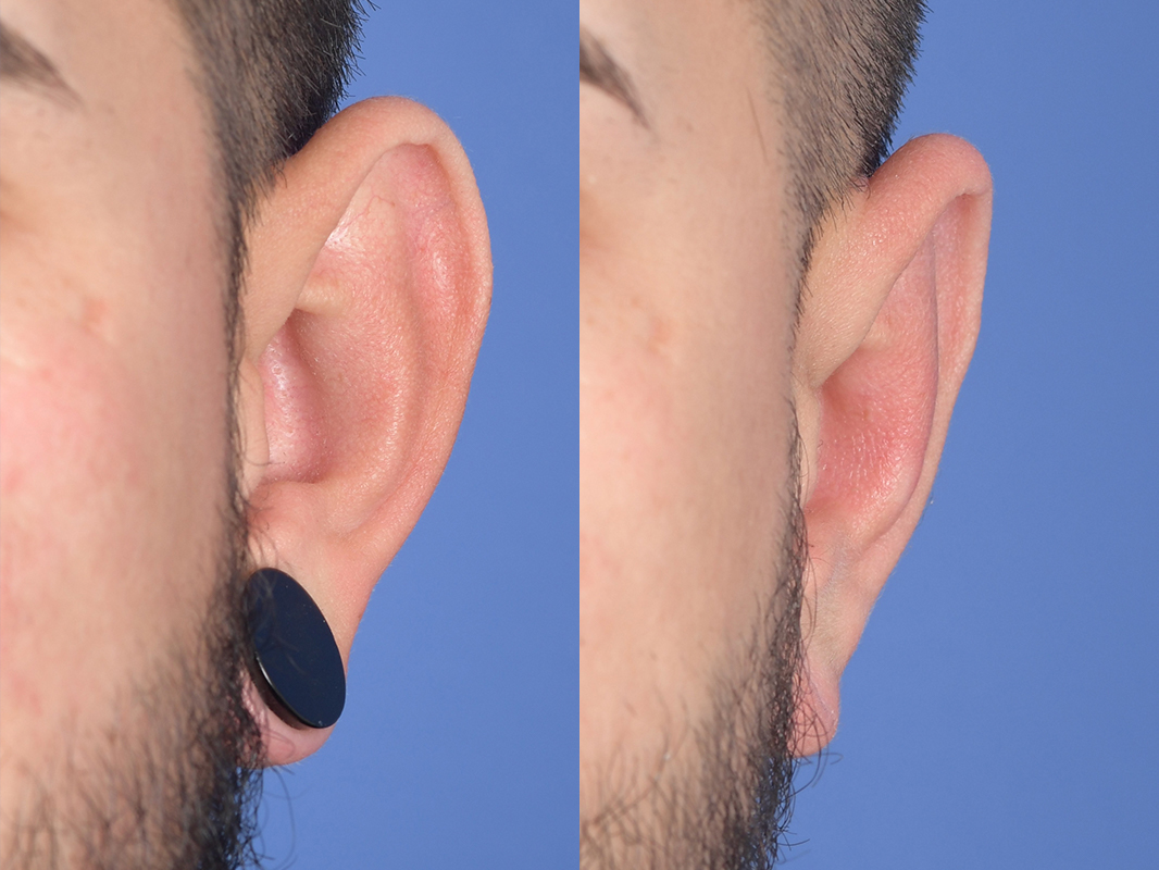 Otoplasty Before and After | Weber Facial Plastic Surgery