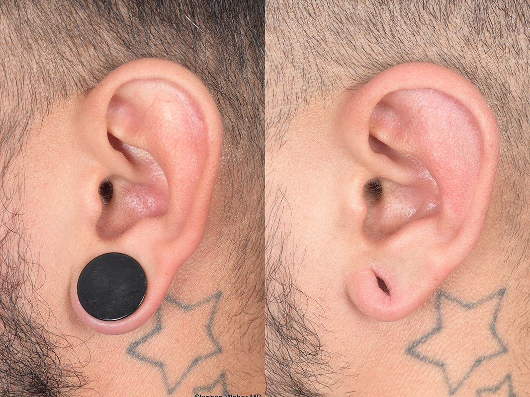 Otoplasty Before and After | Weber Facial Plastic Surgery