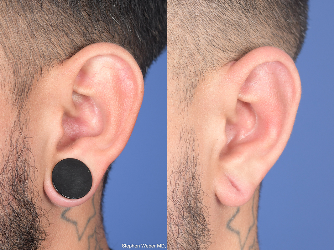 Otoplasty Before and After | Weber Facial Plastic Surgery