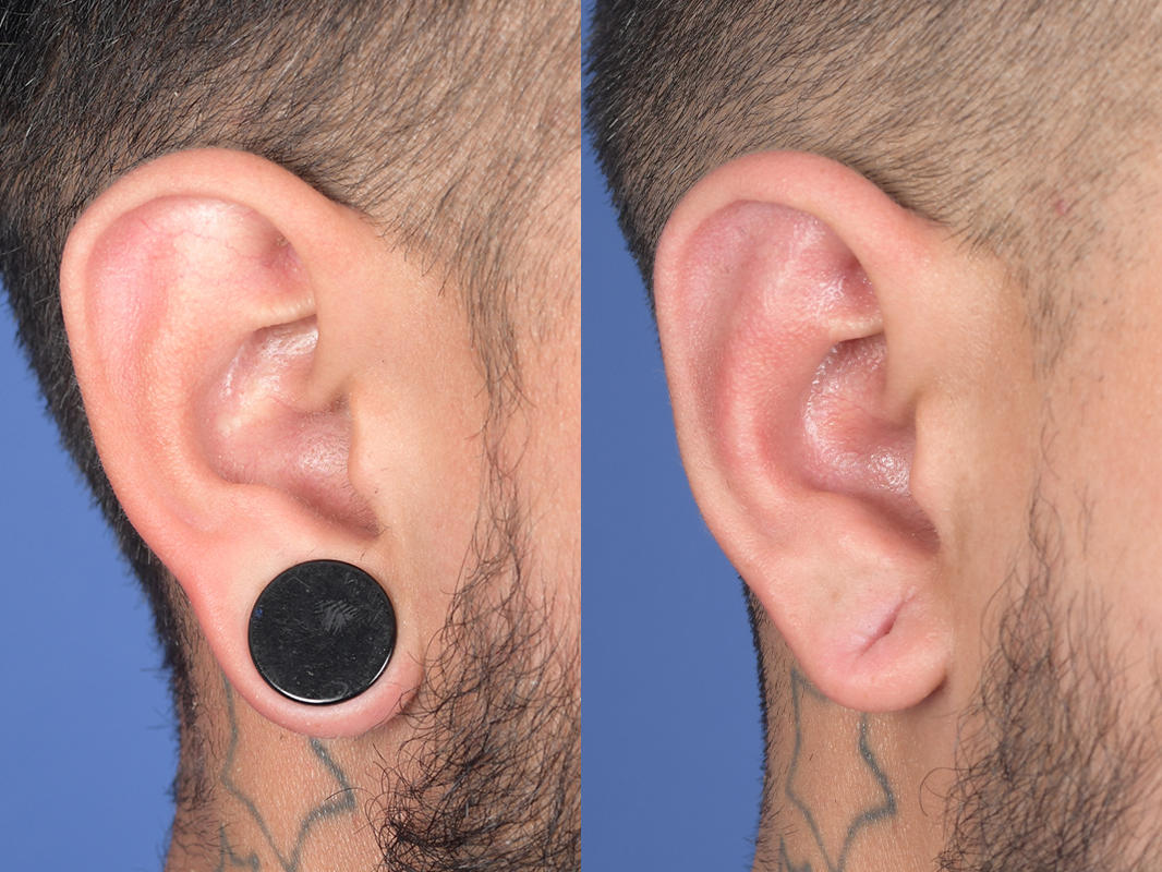 Otoplasty Before and After | Weber Facial Plastic Surgery