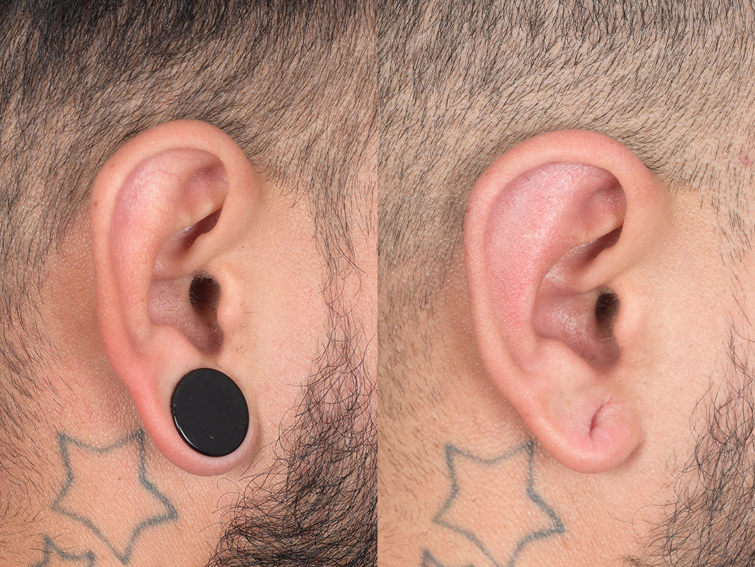Otoplasty Before and After | Weber Facial Plastic Surgery