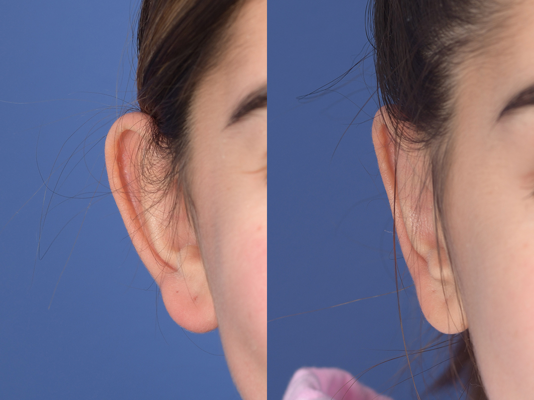 Otoplasty Before and After | Weber Facial Plastic Surgery