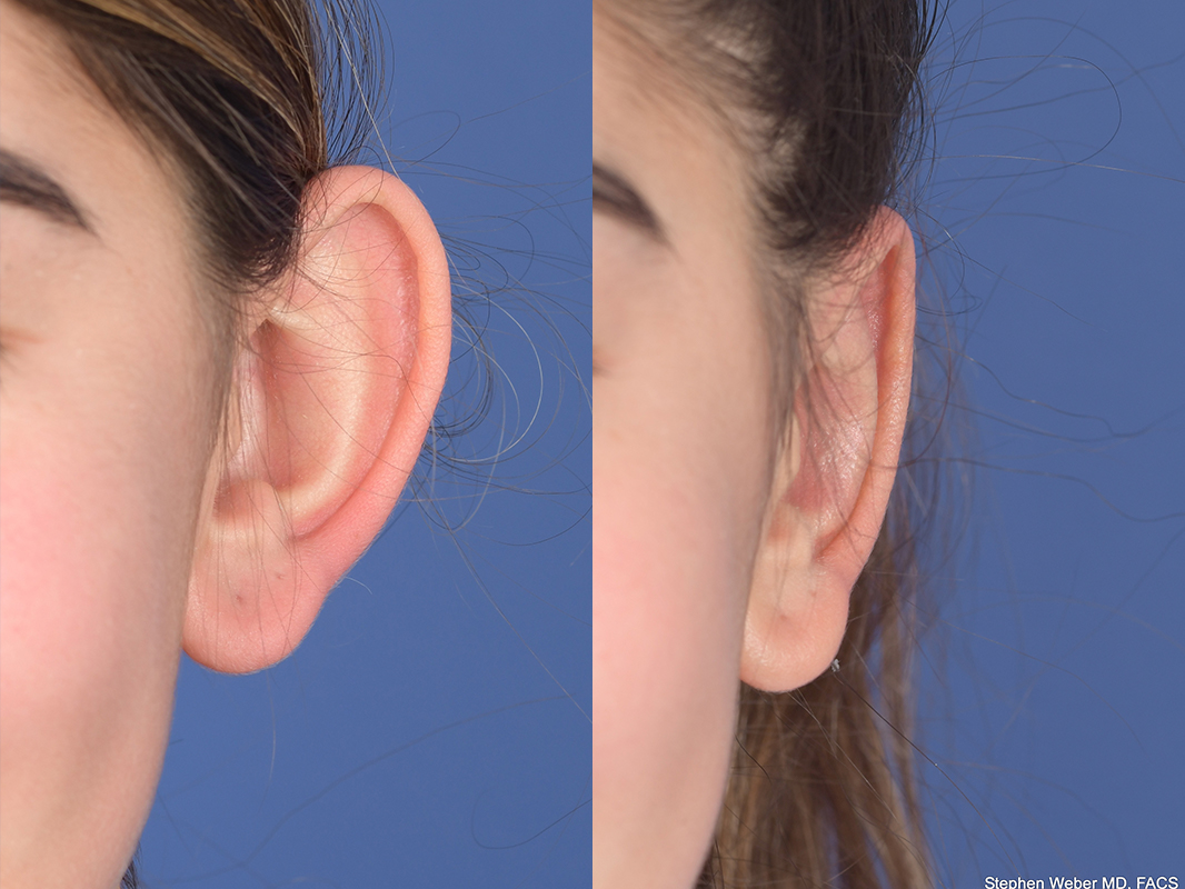 Otoplasty Before and After | Weber Facial Plastic Surgery