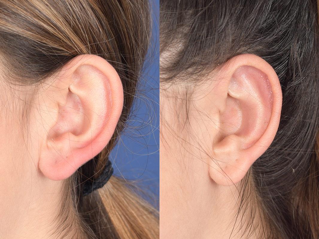 Otoplasty Before and After | Weber Facial Plastic Surgery