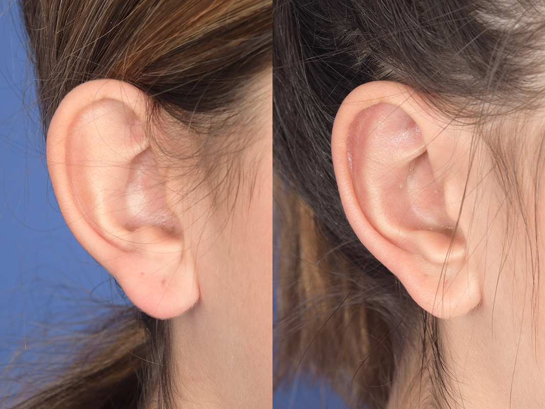 Otoplasty Before and After | Weber Facial Plastic Surgery