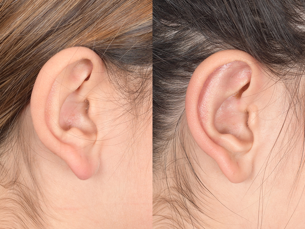 Otoplasty Before and After | Weber Facial Plastic Surgery
