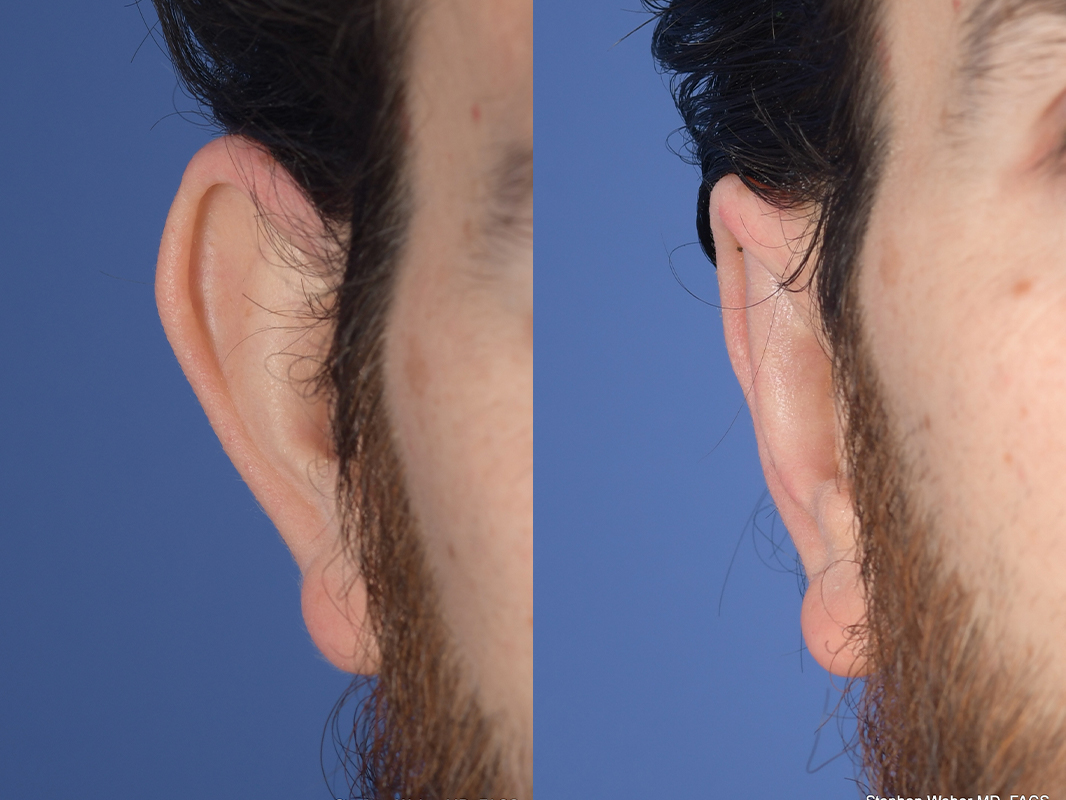 Otoplasty Before and After | Weber Facial Plastic Surgery