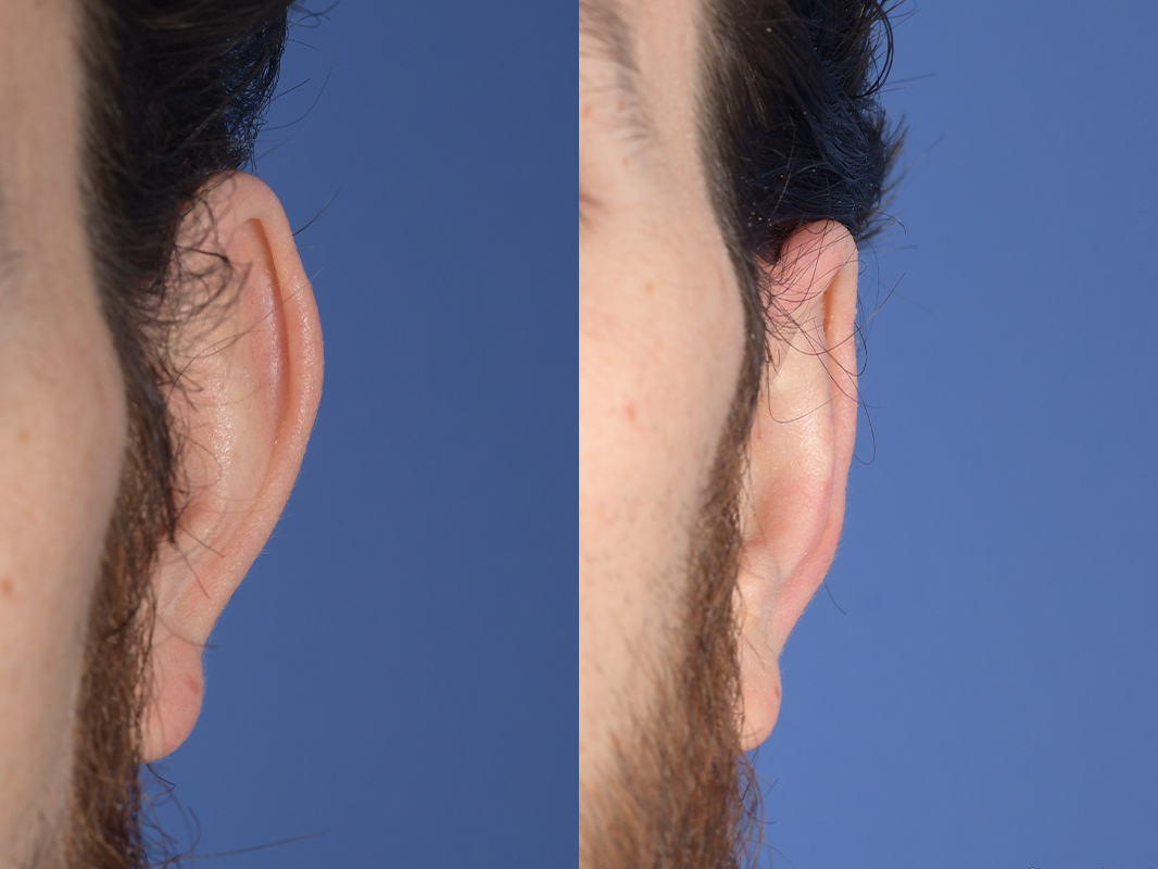 Otoplasty Before and After | Weber Facial Plastic Surgery