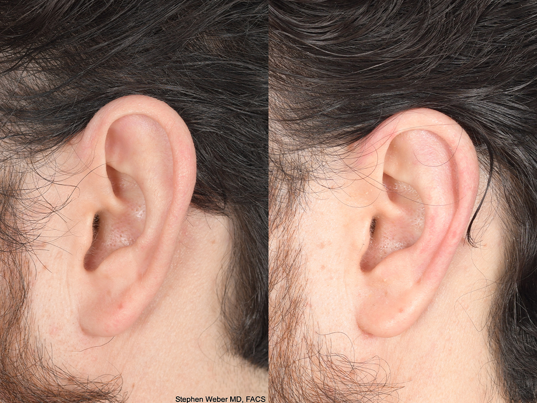 Otoplasty Before and After | Weber Facial Plastic Surgery