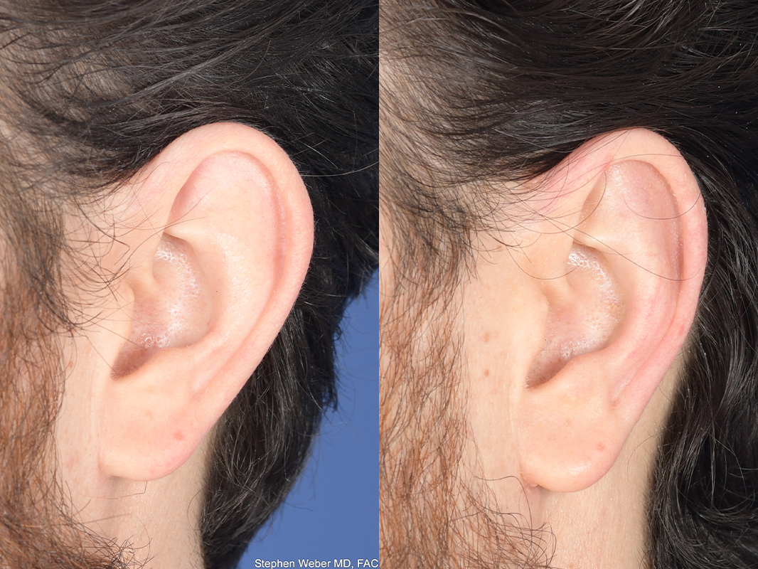 Otoplasty Before and After | Weber Facial Plastic Surgery