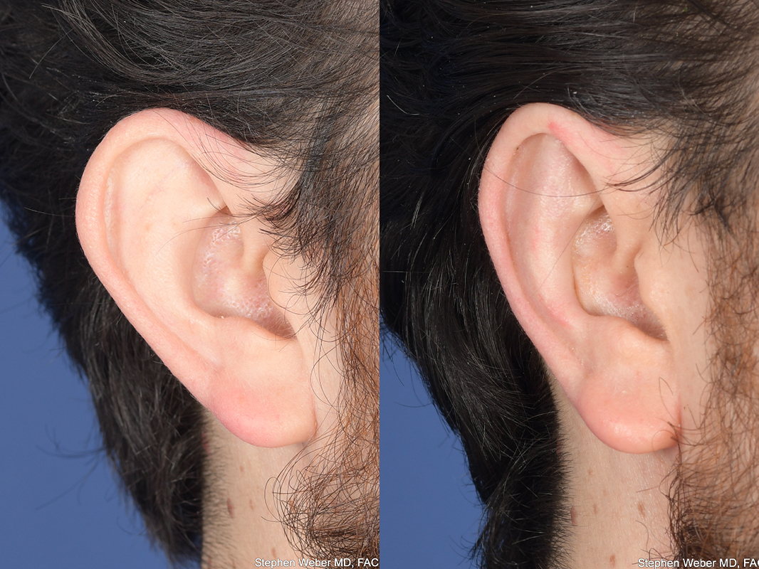 Otoplasty Before and After | Weber Facial Plastic Surgery