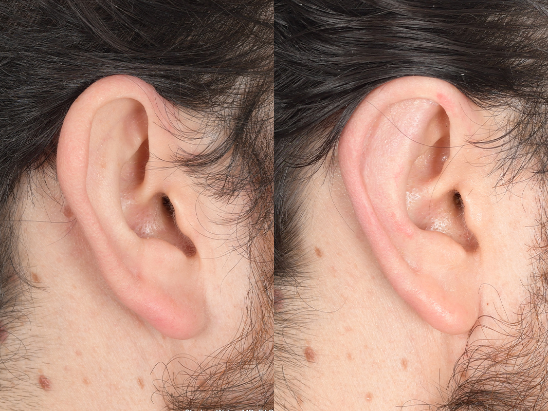 Otoplasty Before and After | Weber Facial Plastic Surgery