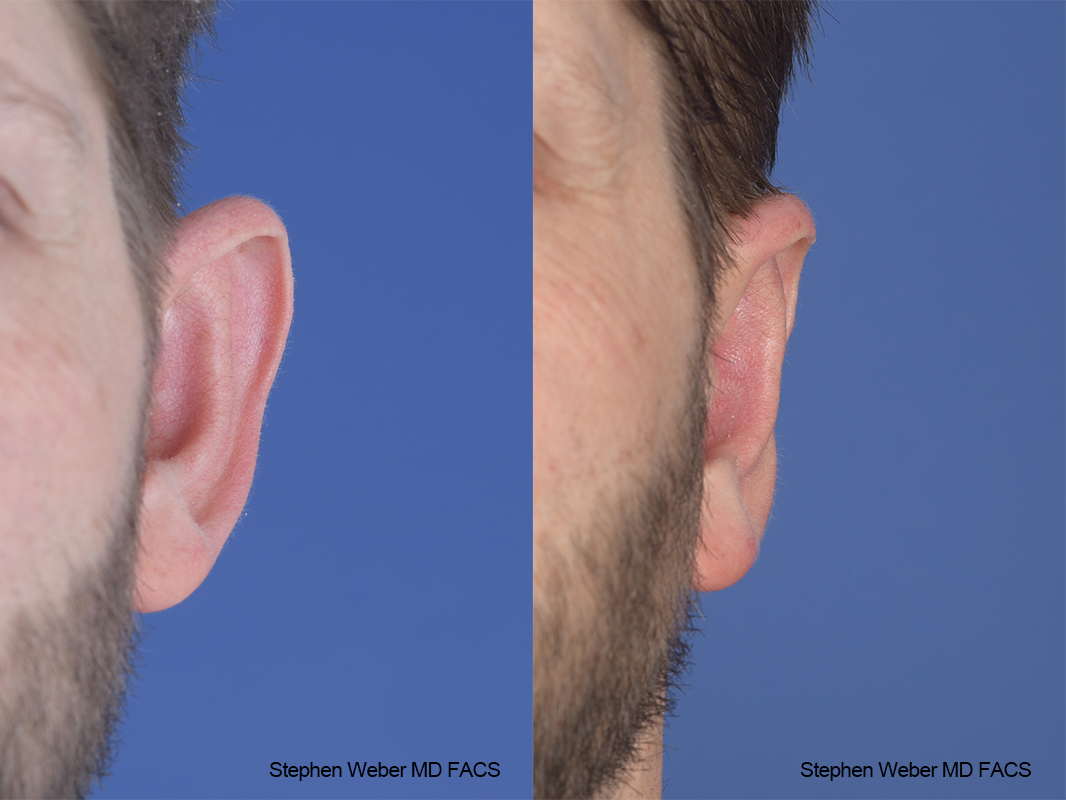 Otoplasty Before and After | Weber Facial Plastic Surgery