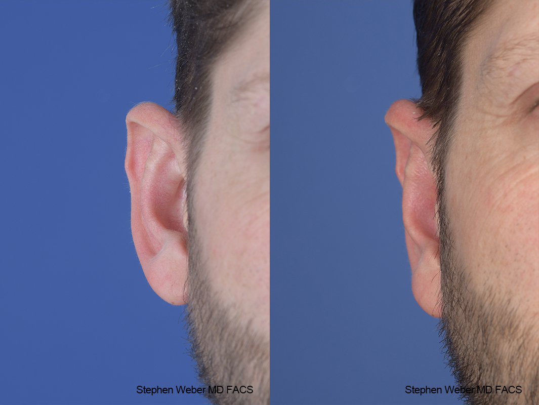 Otoplasty Before and After | Weber Facial Plastic Surgery