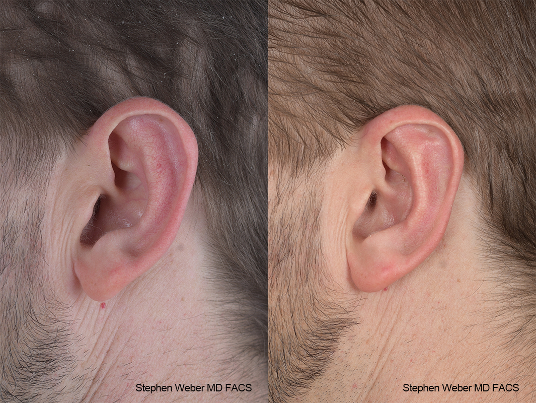 Otoplasty Before and After | Weber Facial Plastic Surgery