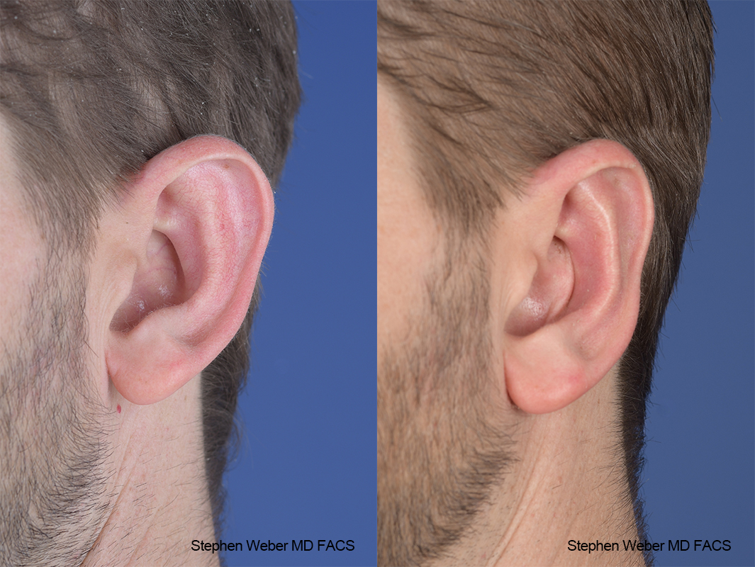 Otoplasty Before and After | Weber Facial Plastic Surgery
